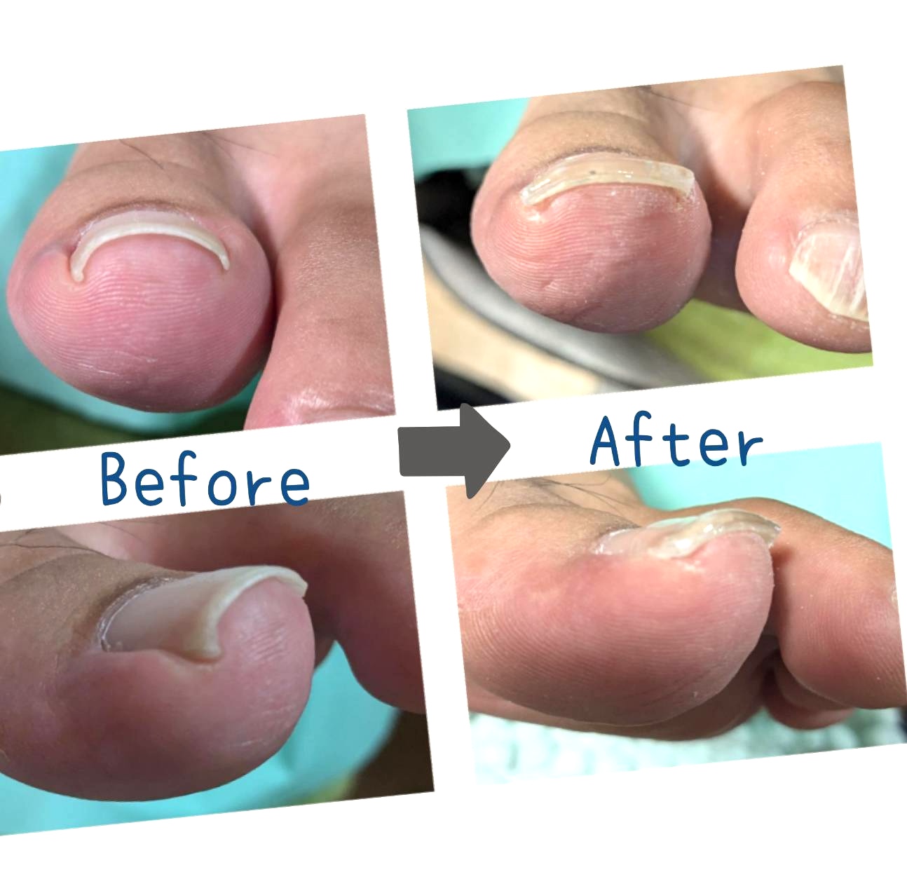 看護師のフットケアと巻き爪補正〜あしゆめ〜｜つなぐっど｜あなたの街